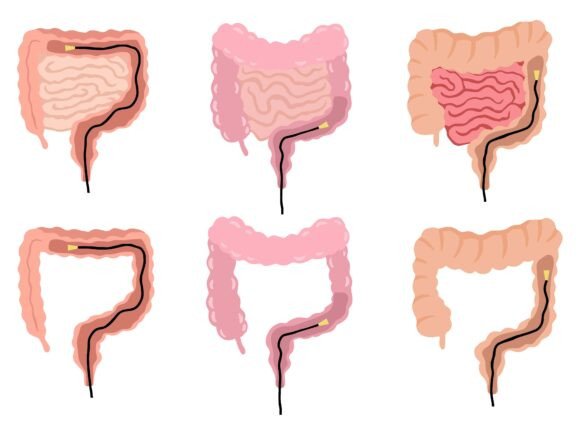 Colonoscopy in Intestinal Colon