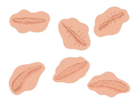 Scar Skin Repaired Tissue Illustration